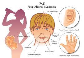 Fetal Alcohol Syndrome What I Wish I D Known Healthy Mom Baby
