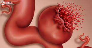 Aneurysms are potentially fatal if they rupture. The Rupture Of Aortic Aneurysms A Medical Emergency That Might Lead To Sudden Cardiac Death Bangkok Heart Hospital