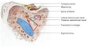 We studied trautmann's triangle anatomy and its area in transpetrosal approaches. Surgical Classification Of Variations In The Anatomy Of The Sigmoid Sinus Sciencedirect