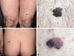 Welche symptome auf die erkrankung hinweisen können, erfahren sie hier. Foudroyant Verlaufendes Malignes Melanom Bei Urticaria Pigmentosa Springerlink