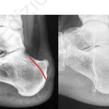 The type of procedure depends on. Pdf Treating Haglund S Deformity With Percutaneous Achilles Tendon Decompression A Case Series