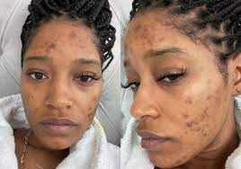 The contraceptive pill causes excess body and facial hair. Keke Palmer S Polycystic Ovary Syndrome Pcos Diagnosis Explained