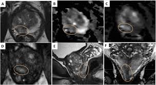 Radiation therapy for prostate cancer. Multiparametric Magnetic Resonance Imaging For The Detection Of Clinically Significant Prostate Cancer What Urologists Need To Know Part 2 Interpretation European Urology