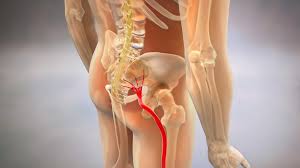 Image result for Sciatica