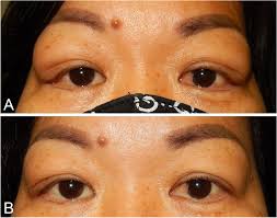 Image result for Dacryoadenitis