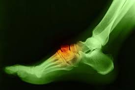 There are two ways to get rid of. Bony Bumps On The Top Of Your Feet Could Be Bone Spurs Next Step Foot Ankle Clinic Foot And Ankle Surgeons