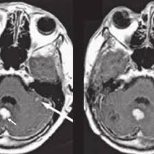 Pdf Brain Tumour Imaging