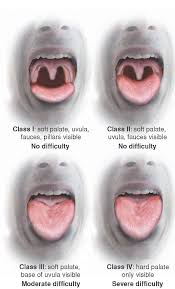 In anesthesia, the mallampati score (or mallampati classification) is used to predict the ease of intubation. Pin On Patient Inspection Etc