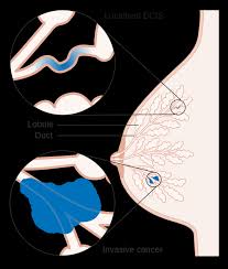 Invasive cancer, and it was therefore treated by mastectomy. Breast Carcinoma In Situ Lobular Ductal Lcis Dcis Teachmesurgery