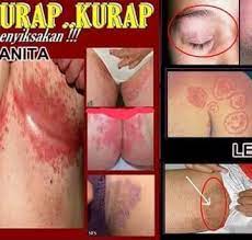 Ubat tradisional krim daun gelenggang utk panau kudis kurap dan gatal kulit. Ubat Mujarab Kurap Dan Gatal Home Facebook