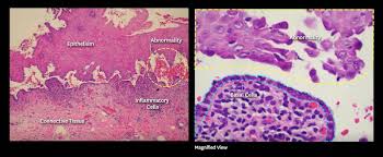 Image result for Pemphigus