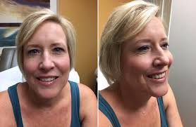 It affects people of all races, genders and ages, which is why it's absolutely critical for americans to learn about. What Does Squamous Cell Carcinoma Look Like Spot Above Lip Was Skin Cancer
