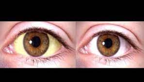 Como Aclarar Los Ojos Y Quitar Lo Amarillento Con Remedios Caseros Unisalia