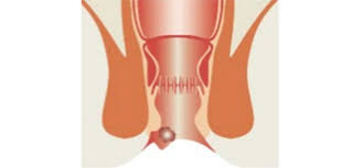 Image result for hemoroid human