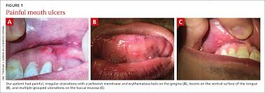 Image result for Labial mucosa