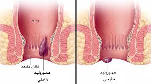 بواسیر داخلی و خارجی چیست علائم و روش های درمان آن دکتر بیژن عابدیان