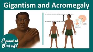 Image result for Acromegaly
