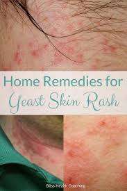 Skin Yeast Infection Home Remedies You Must Try Bliss Health Coaching Yeast Infection Home Remedy Chronic Yeast Infection Yeast Infection On Skin