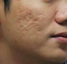The market's top offerings await you below. 10 Best Acne Scar Removal Creams For Indian Men Mensopedia