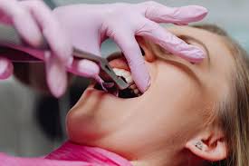 Image result for Tooth Extraction