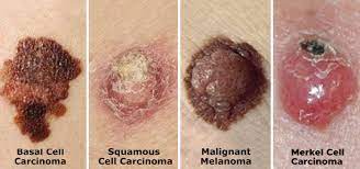 Learn more about the different types of skin cancer, so you can spot potential problems early. Skin Cancer Introduction Statistics And Types Of Skin Cancer Surgmedia