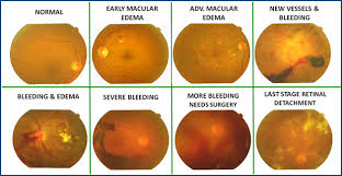 Diabetic Retinopathy Treatment In Pune Diabetic Retinopathy Treatment