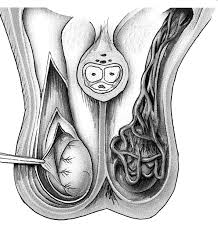 Image result for Varicocele