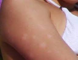 How do i get rid of them? answered by dr. White Spots Appear On A Tan Dark Tanning Spots Sunspots Have To Remove From The Diet