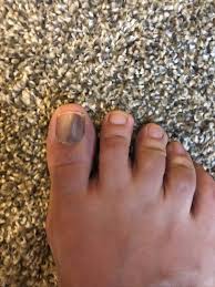 Image result for Acral lentiginous melanoma nail