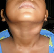 Malaysian Family Physicians - A child with epistaxis, reduced ...