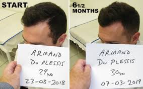 He is dedicated exclusively to treating hair loss in both men and women. Dr Alexander Hairloss