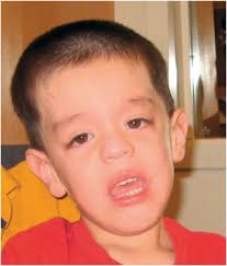 Fragile X clinical features and neurobiology