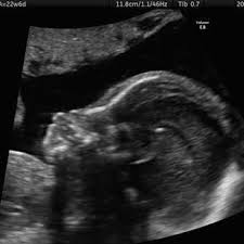 The fetal ultrasound, or sonogram, has become a routine aspect of prenatal care for most pregnant women. 2d 3d 4d Ultrasound Of The Fetal Face In Genetic Syndromes Radiology Key