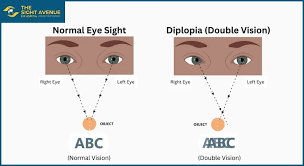 Image result for Diplopia