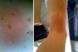 Braune Flecken Am Ganzen Korper Juderm Ist Eine Ag Des Bvdd Fur Studenten Weiterbildungsassistenten Und Alle Jungen Dermatologen