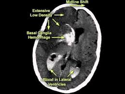 La isquemia cerebral es una afección directamente al cerebro humano, donde el aporte sanguíneo la isquemia cerebral se trata de una enfermedad o accidente cerebrovascular que afecta el flujo de. Evolucao Da Isquemia Cerebral Youtube