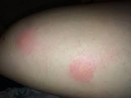 Grosse Rote Harte Muckenstiche Ist Das Gefahrlich Krankheit Insektenstich