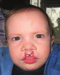 LARRY J. MOORE, DDS, MS RUNS FOR AAOMS VICE PRESIDENT