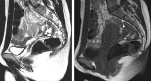 Endometriosis is a full body condition in which cells similar to those in the endometrium, the layer of tissue that normally covers the inside of the uterus, grow outside the uterus. Mri Atlas Of Ectopic Endometriosis Sciencedirect