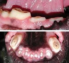 Image result for Tooth Attrition