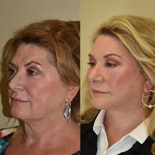 TOP 10 BEST Cosmetic Surgeons near Worthington, OH