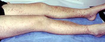Senile purpura is a common, benign condition characterised by the recurrent formation of purple ecchymoses (bruises) on the extensor surfaces of forearms following minor trauma. Iga Vasculitis Formerly Henoch Schonlein Purpura Or Hsp Unc Kidney Center