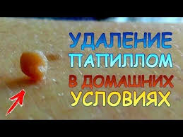 как избавиться от бородавок под мышками в домашних условиях Kak Lechit Virus Papillomy Cheloveka Udalenie Papillom Kondilom Borodavok V Domashnih Usloviyah Youtube Zdorove Smeshnye Smajliki Anatomiya I Fiziologiya
