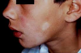 Pityriasis alba is a skin condition that commonly happens to children and to young adults, but any person can acquire it as well. Pityriasis Alba