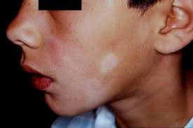 The exact cause is unknown. Pityriasis Alba