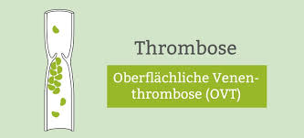 Us und faktor v defekt nehme ich seit 8 jahren marcumar. Oberflachliche Venenthrombose Ovt Thrombophlebitis Armthrombose Pflege De