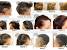 Type 1 Diabetes Hair Loss