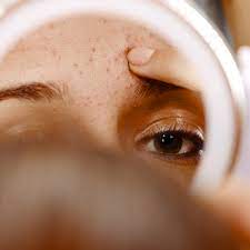 I don't do botox or restalin or anything like that, so i was scared it was something. 15 Things That Happen To Your Skin After In Office Microneedling Newbeauty