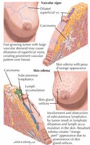 Image result for Inflammatory breast cancer