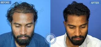 If you trust in the fantastic benefits of contact us. Best Hair Transplant Clinic In India Hair Transplant Clinic In Pune Best Hair Transplant Results